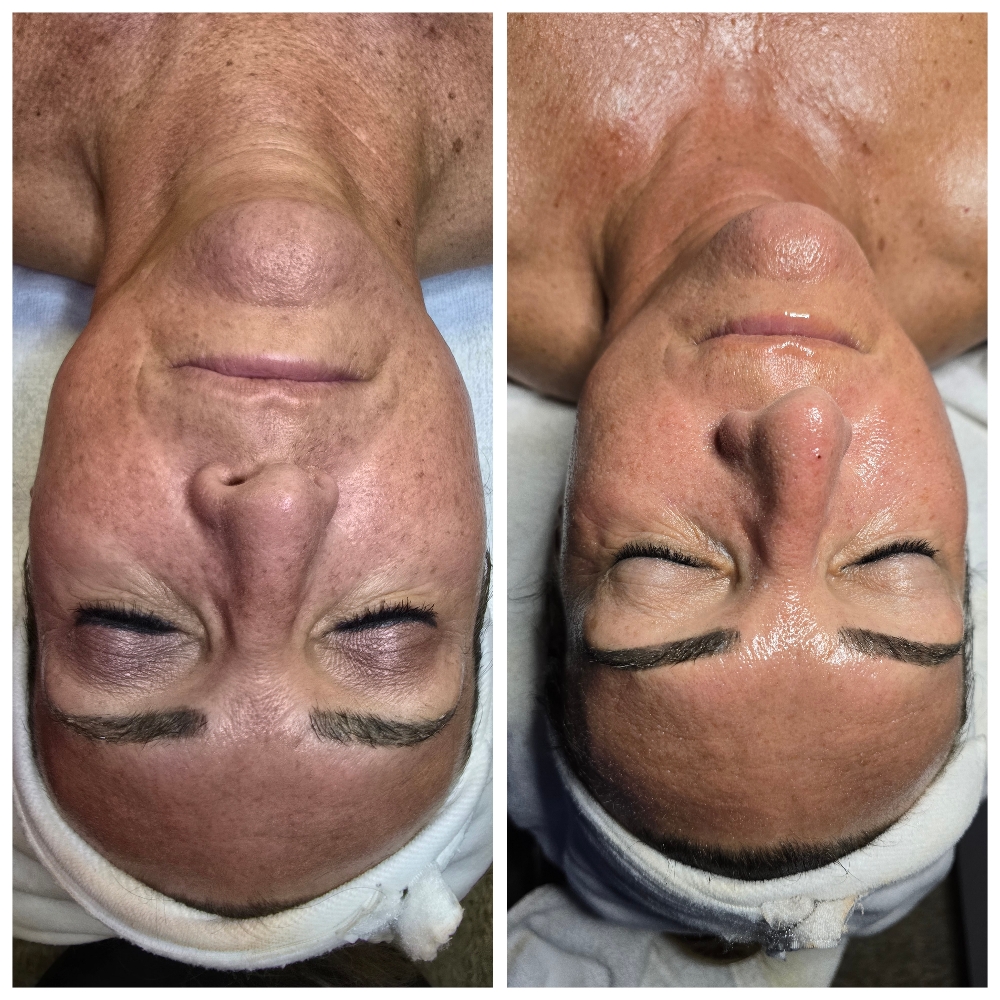 Chemical Peel Facial (60 minutes)