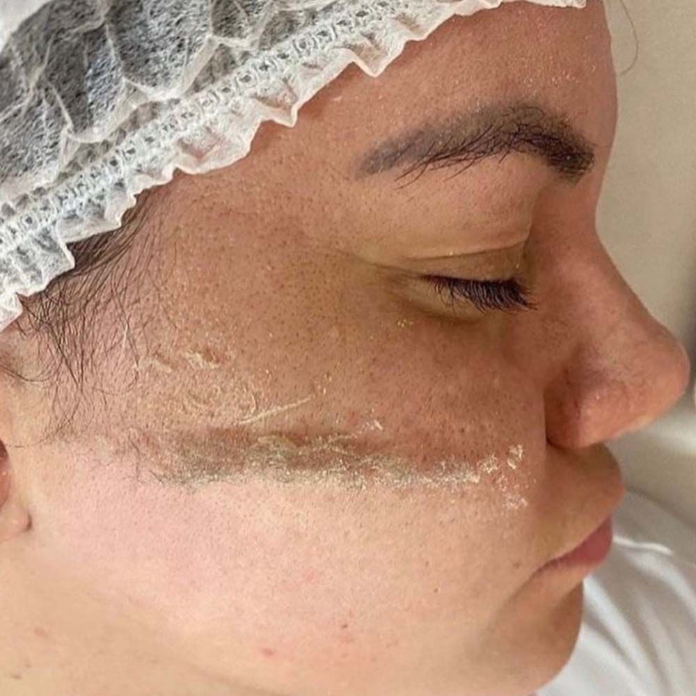 Dermaplanning Facial