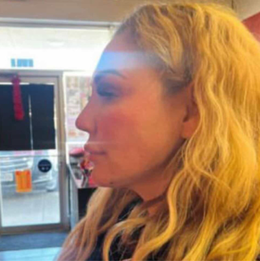 🔻 JAWLINE FILLER at Flawless Spa & Beauty in Fort Worth, TX