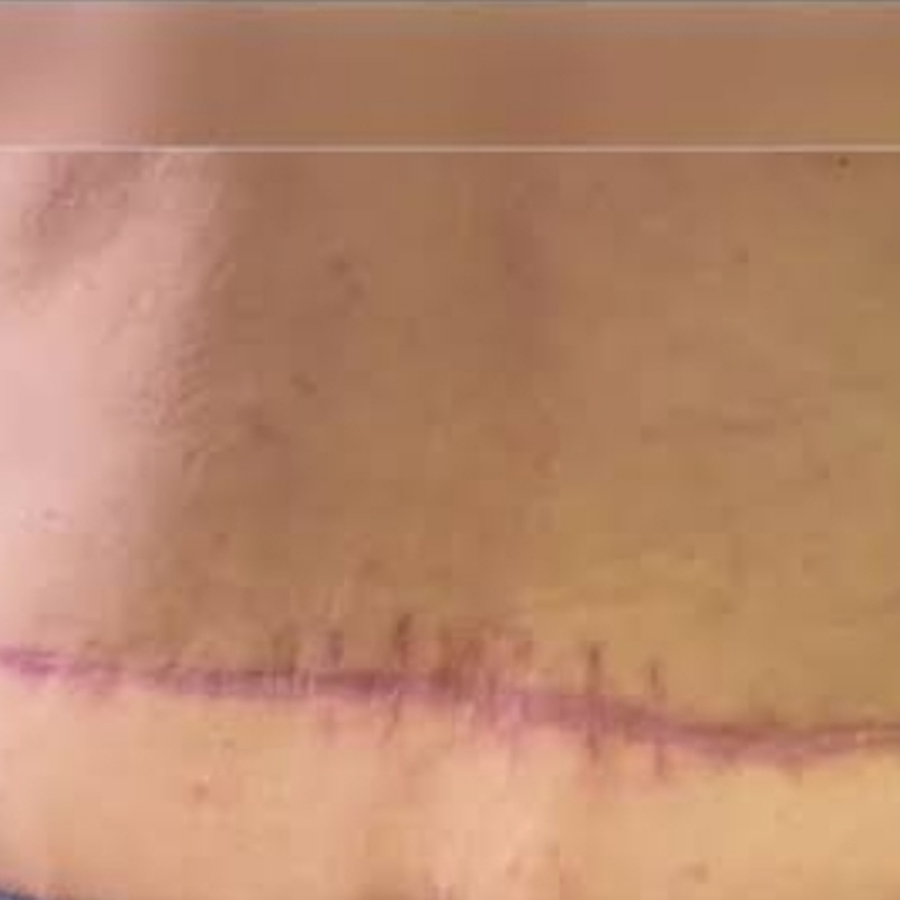 Tummy Tuck 360 Scar Revision at Pamper Me Ink  Paramedical Tattooing in Tucson, AZ
