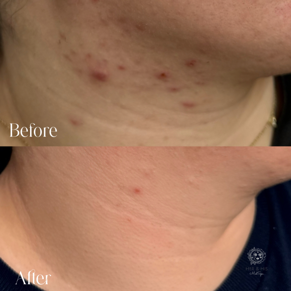 BioRePeel Deluxe at Her & His in Longview, TX