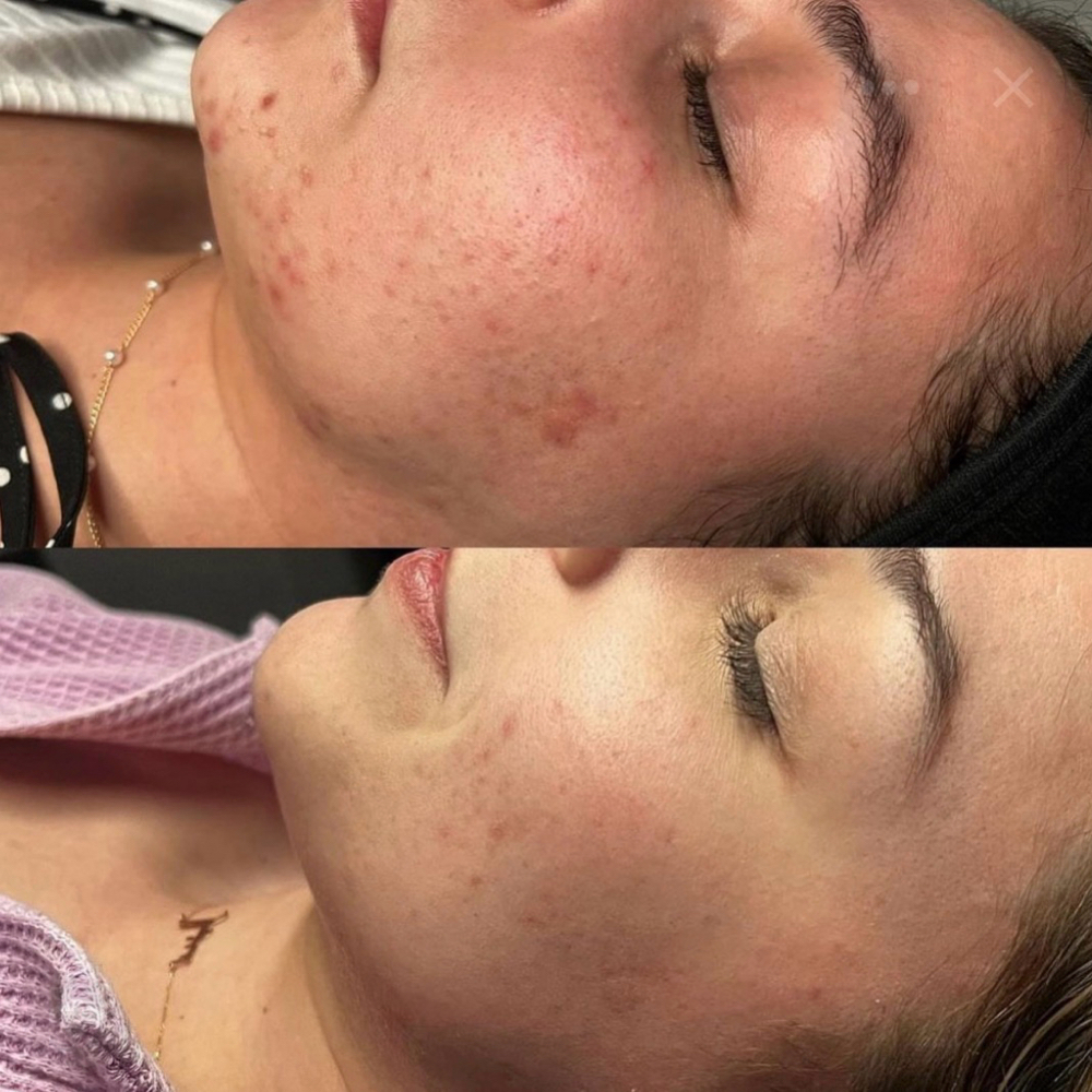 Add On Microchanneling w/ Facial at Re Nu Esthetics by Trina in Ardmore, OK