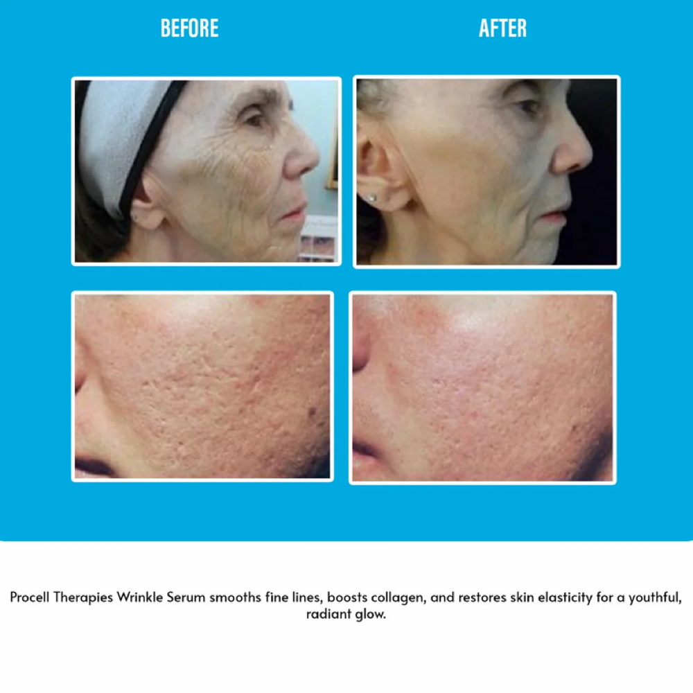Procell Therapy (Microchanling) at KB Esthetic Spa Inc. in Dalton, GA