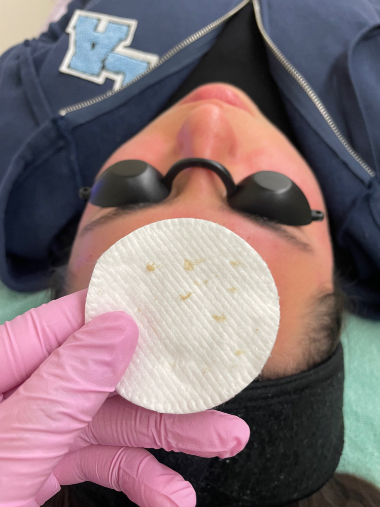 Acne Facial
