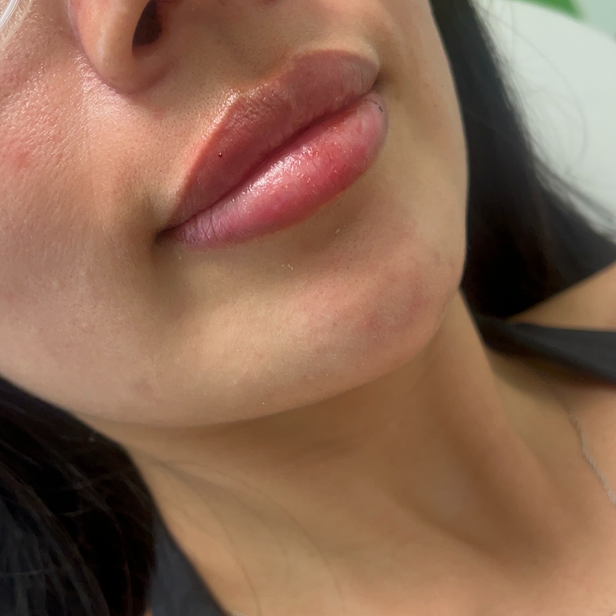 Filler - Full Syringe at Genesis Health and Beauty Bar in Daphne, AL