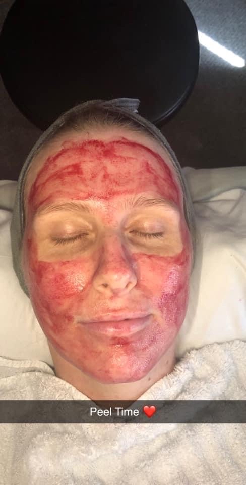 Dermaplaning With Mild Peel