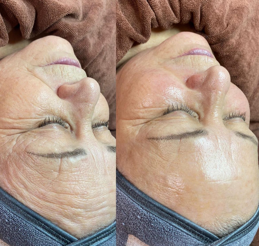 Anti-age Peeling