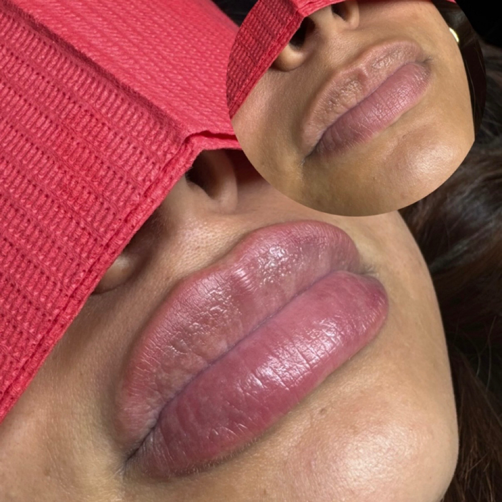 Lip Filler - 1:1ML at Secret Beauty Studio in Ok, OK