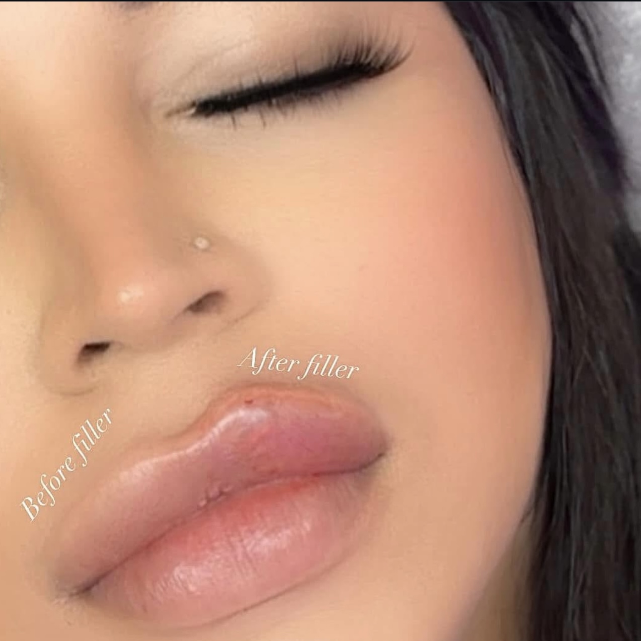 Needleless 1.1ml lip filler
