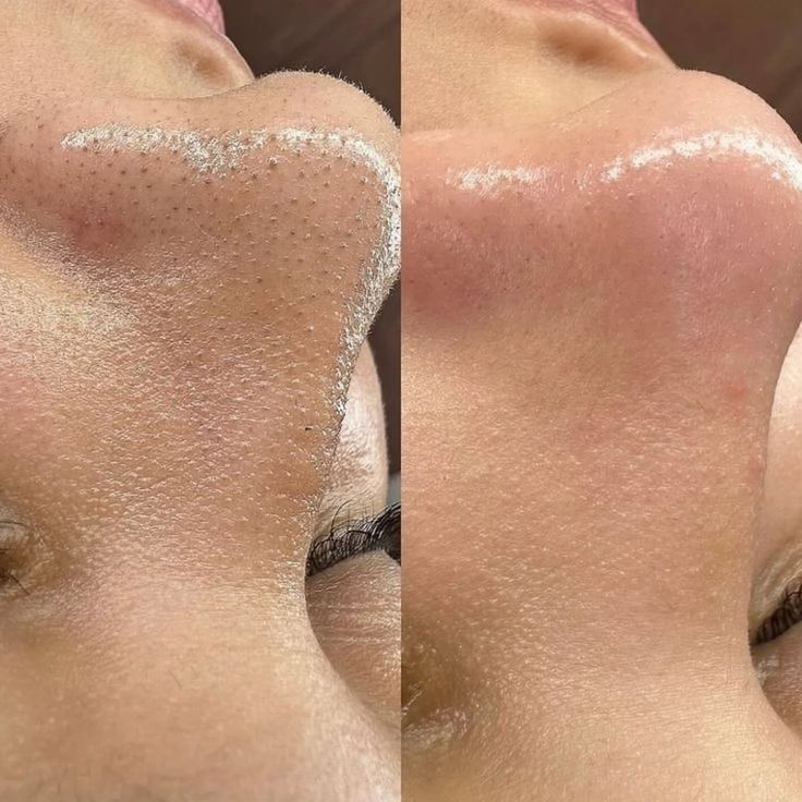 The Pore Purge