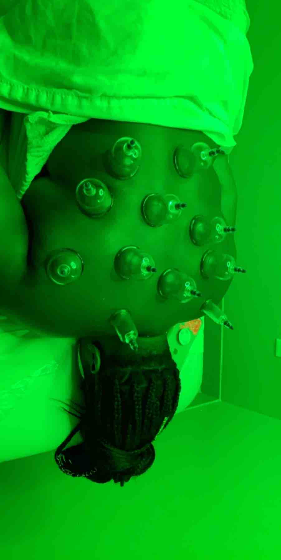Cupping
