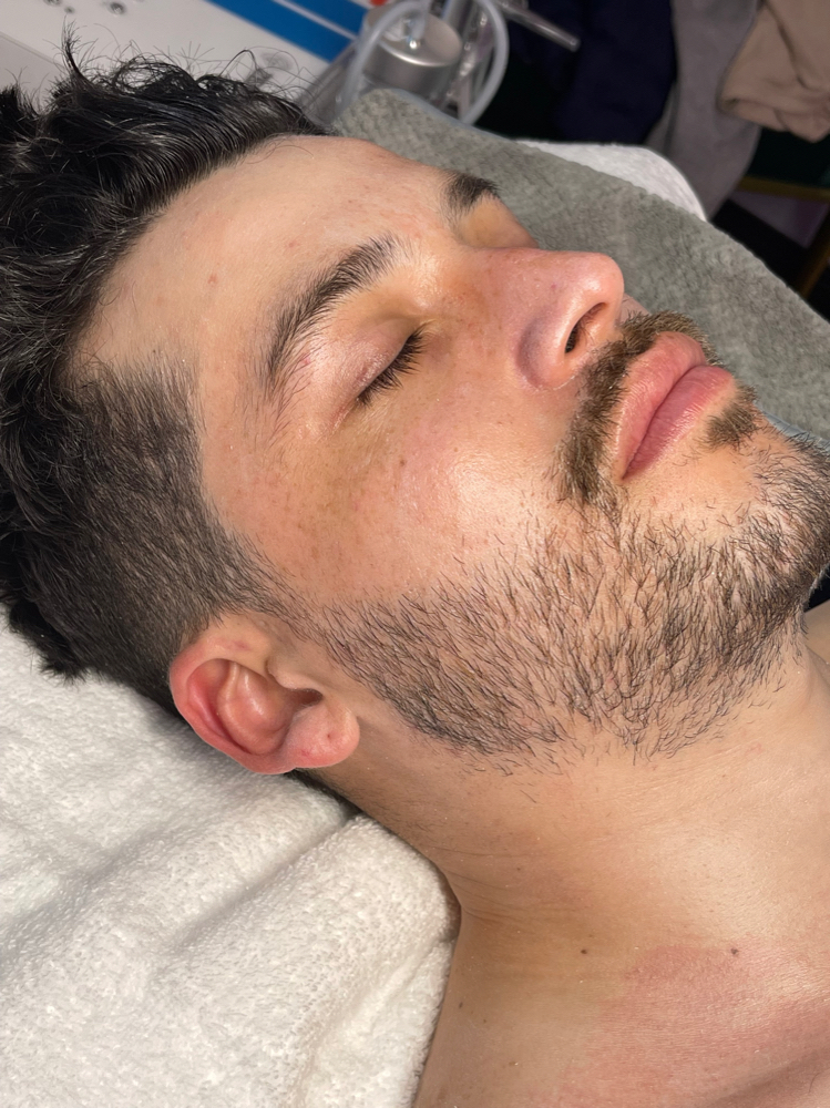 HydroDermabrasion Facial