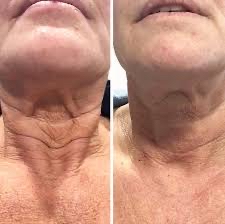 Neck Band Botox!