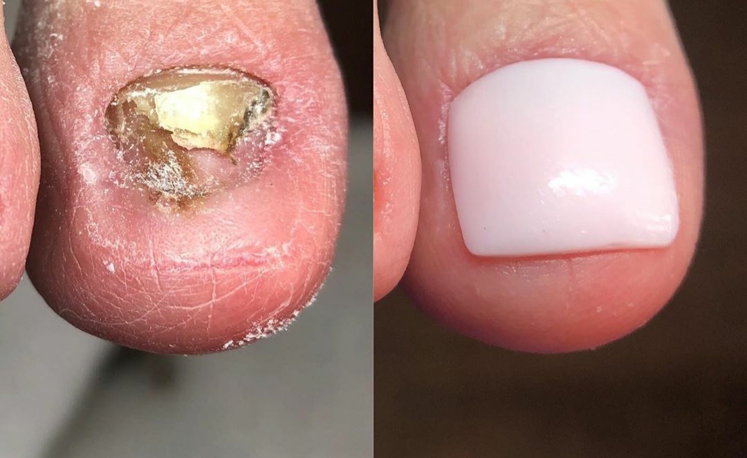 Toenail Reconstruction