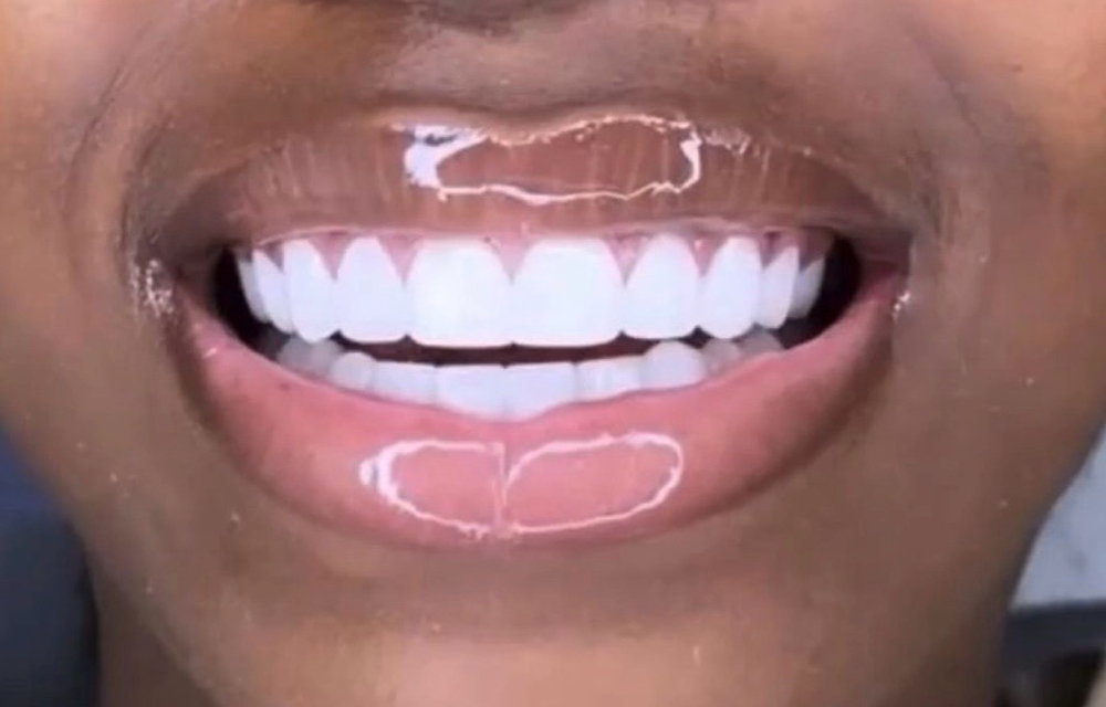 ✨💎Gem Placement On Crowns/Veneers at 💎Kat’s Tooth Gems💎 in Martinsburg, WV