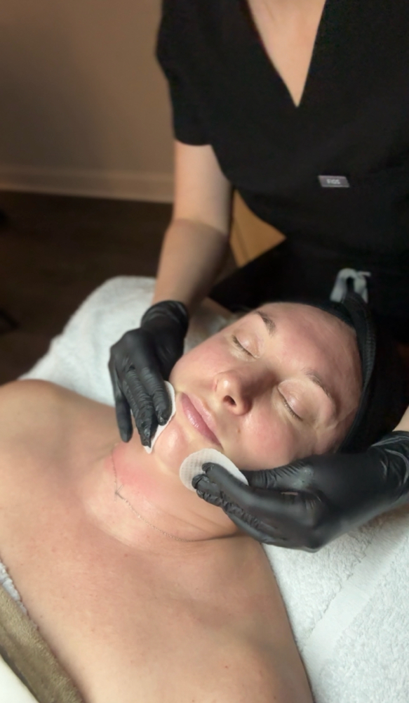 Custom Chemical Peel