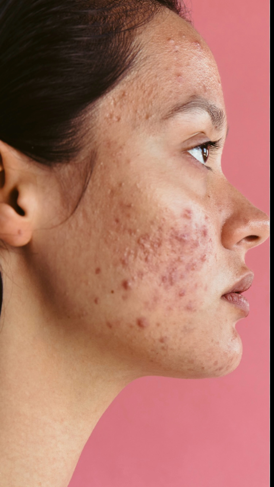 Acne Facial
