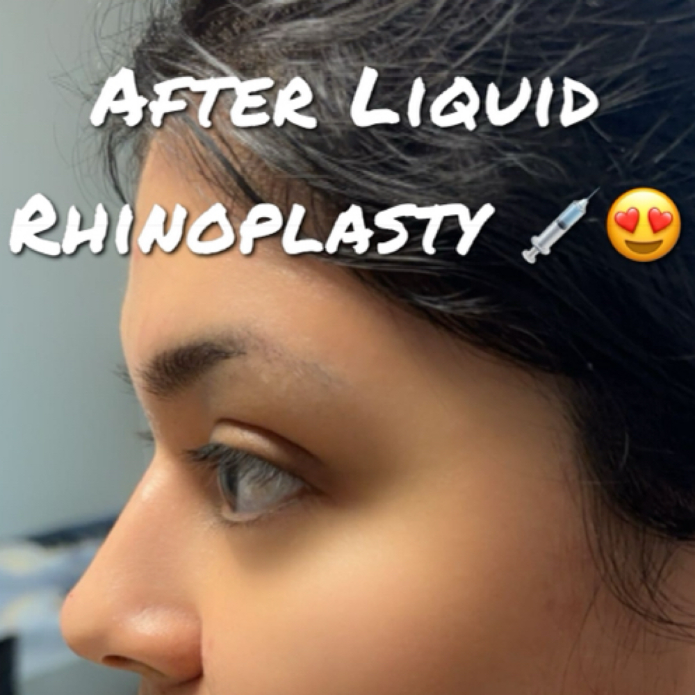 Liquid Rhinoplasty at Abigail Espinoza in Angleton, TX