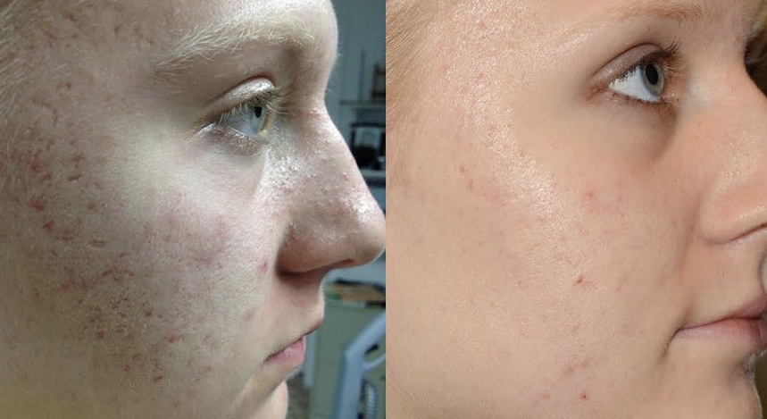 Teen Mini Facial