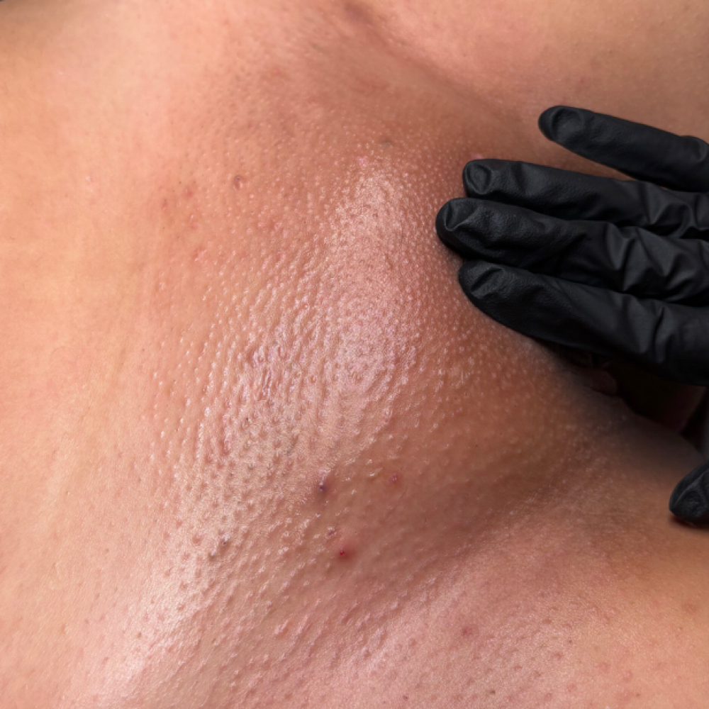 Brazilian Wax at Lins Esthetics in Gaithersburg, MD