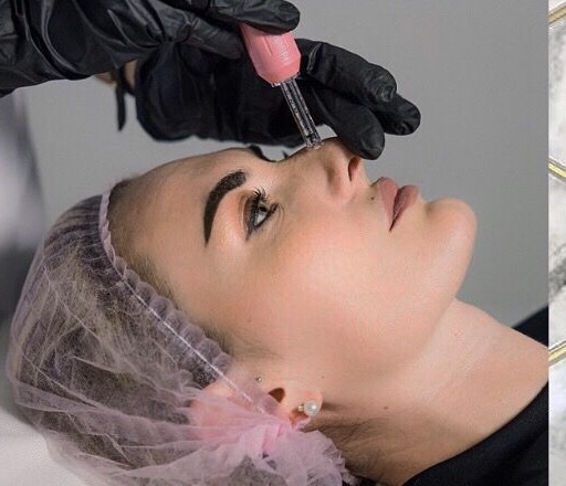 Nose Enhancement Needle-Free Filler