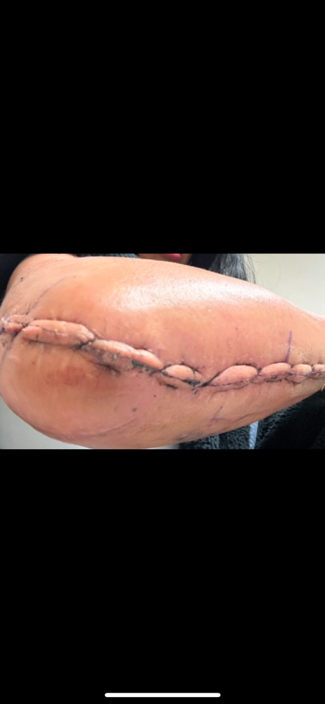 Medical Massage/ Scar Tissue