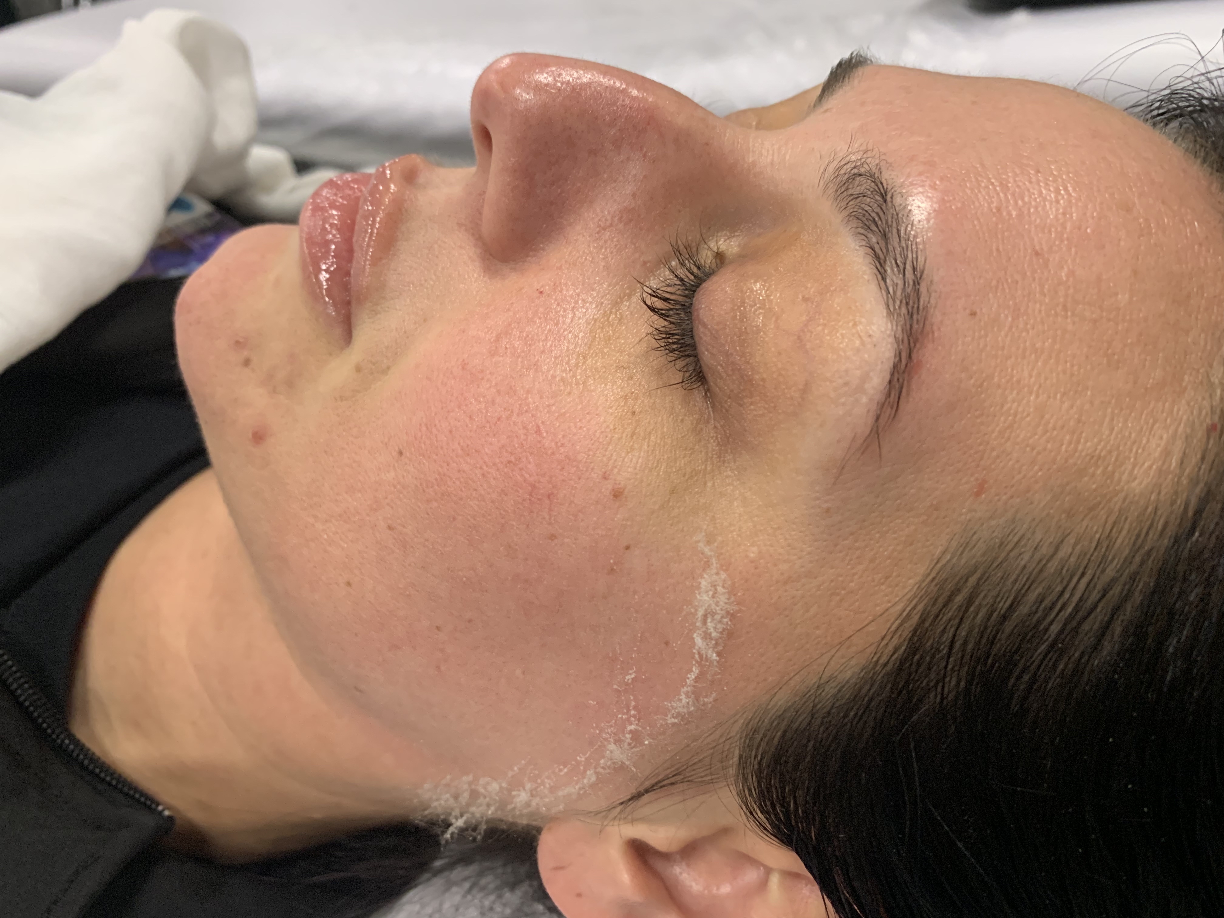Dermaplane Facial