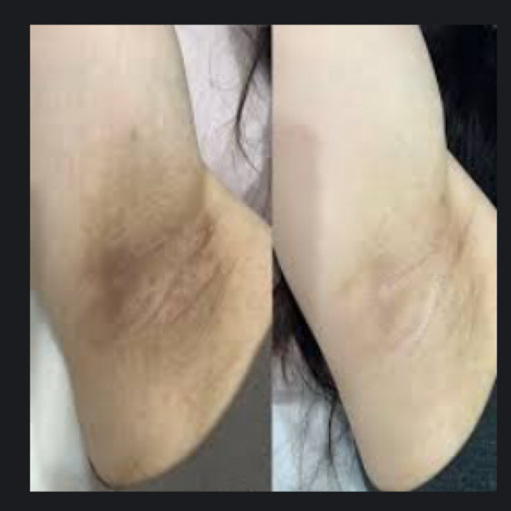 Body Brightening: Upper Body at High Life Image Skincare Studio in Tuscaloosa, AL