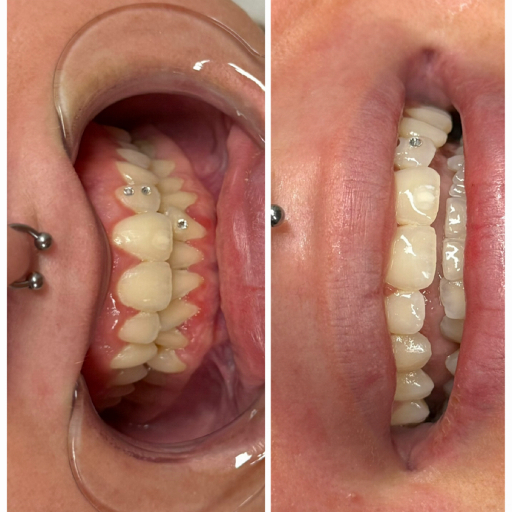Teeth Whitening (1 Session) at Alyssa Rene Esthetics in Lewiston, ID