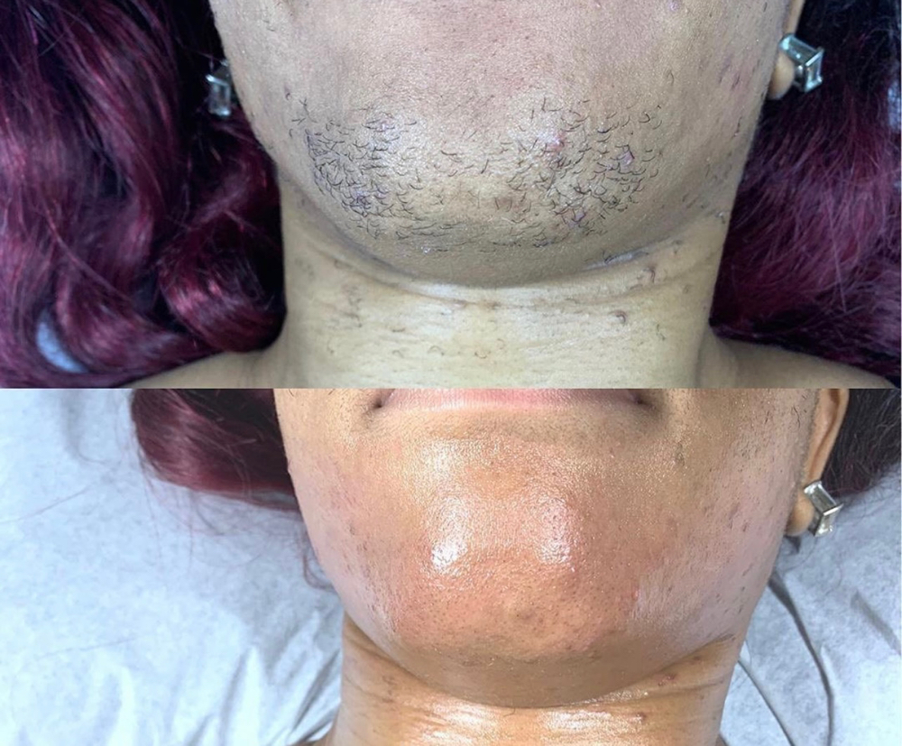 Chin Wax