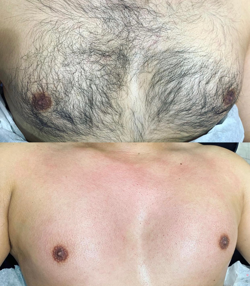 Chest Wax