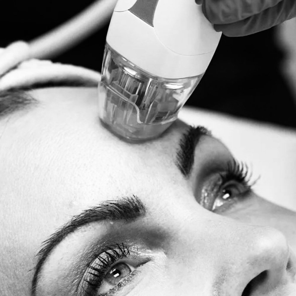 24KT RF Microneedling at Rose And Thorn Day Spa in Wheat Ridge, CO