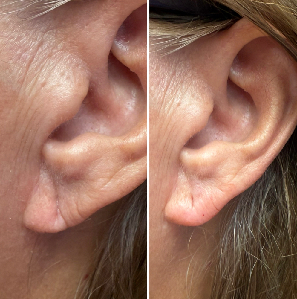 Earlobe Restoration Special 👂 at Bella Rose Aesthetics in San Antonio, TX
