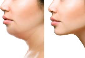 Dermal Filler-Chin