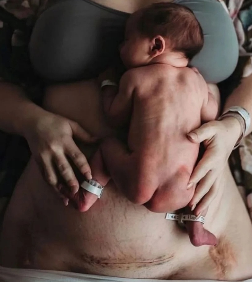 C-Section Scar Minimization
