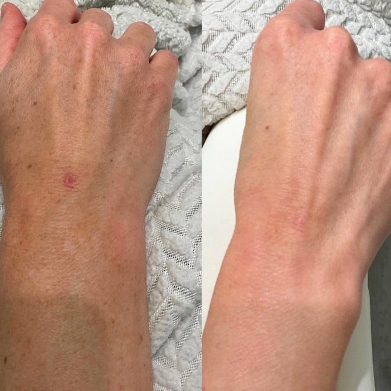 BBL Hands at The Skin Concierge in Northbrook, IL