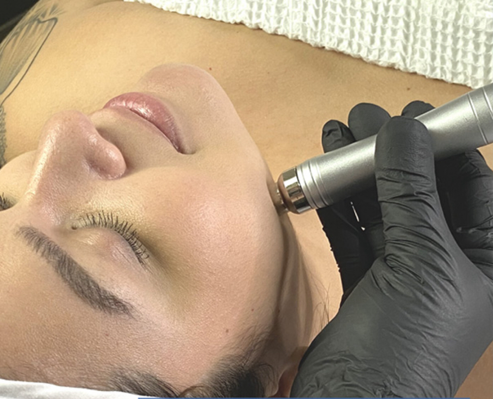 Microdermabrasion