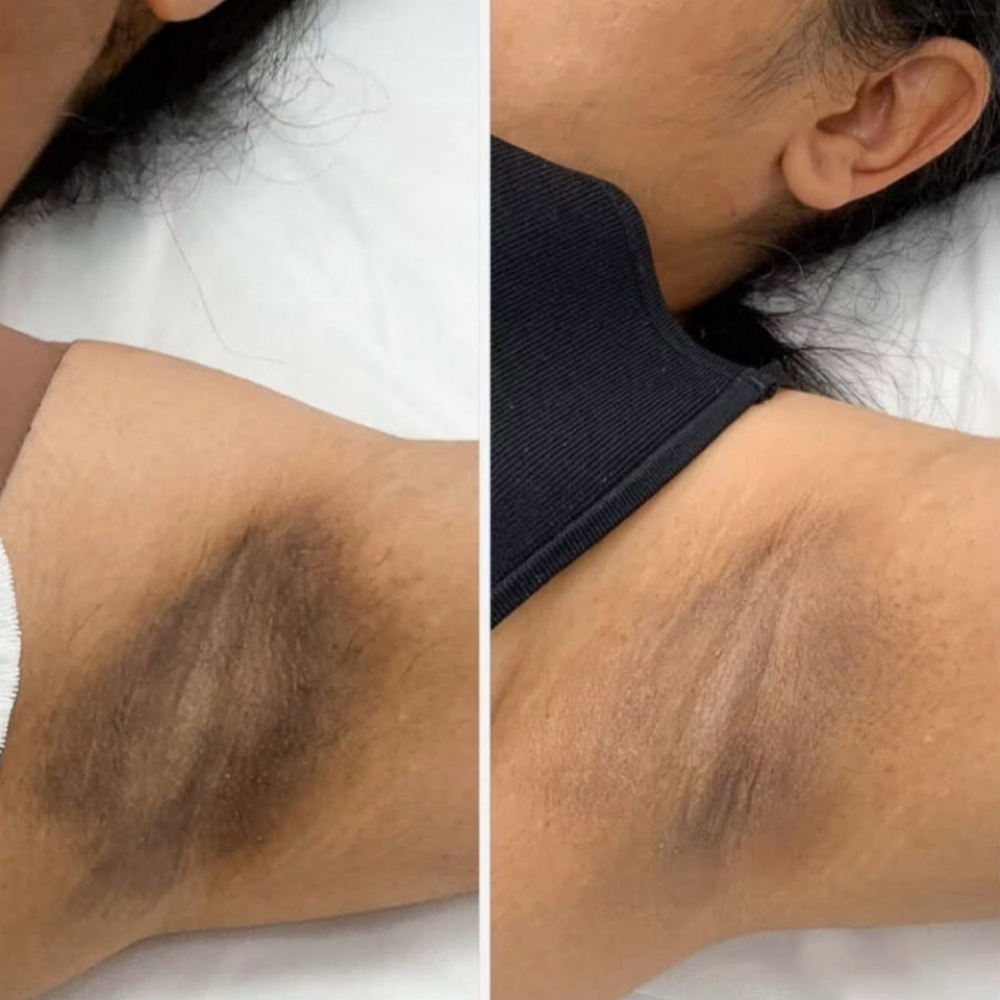 Underarm Removal Of Dark Spots at Amethyst Spa in Omaha, NE