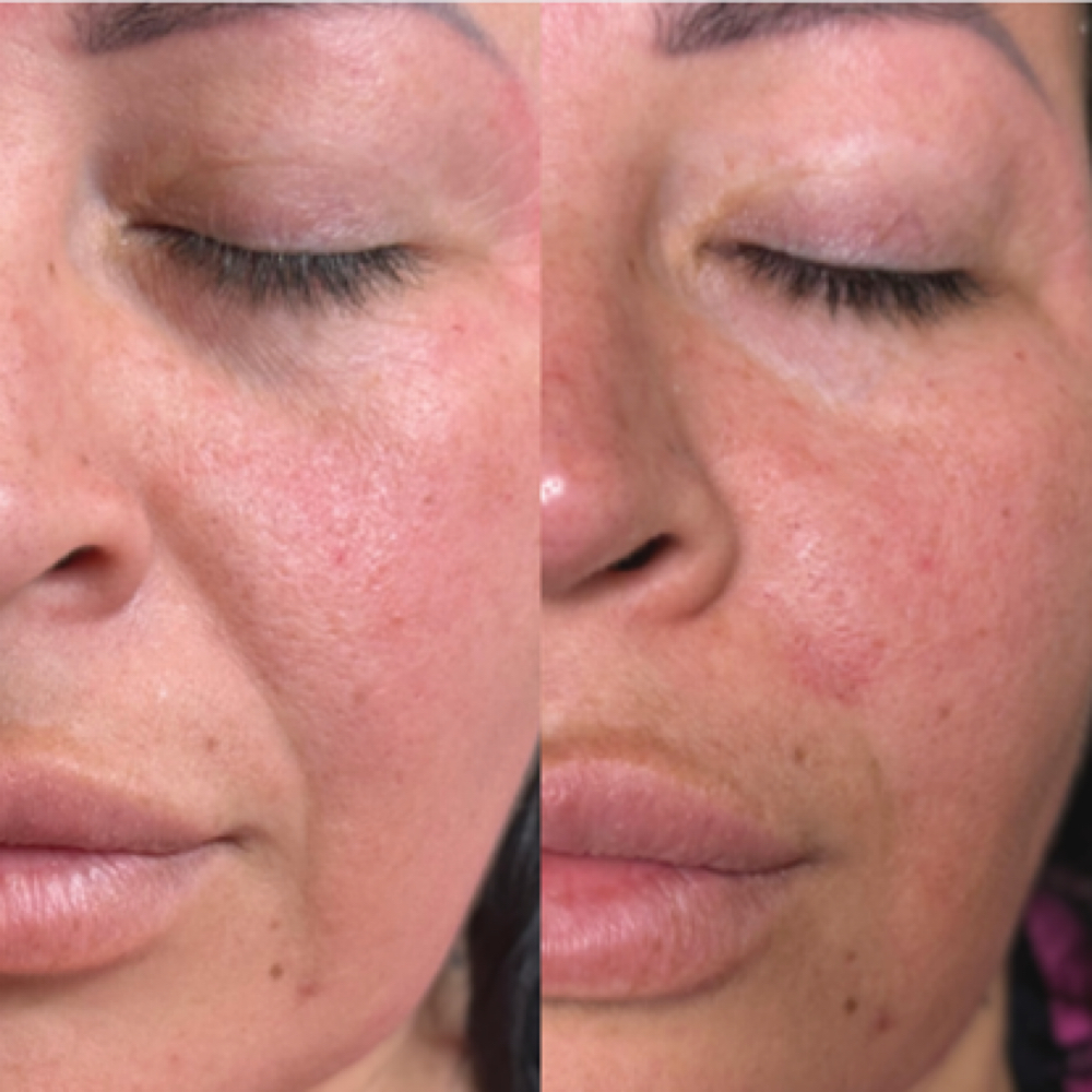 Nasolabial Folds Filler at Aether Aesthetics in Midland, TX