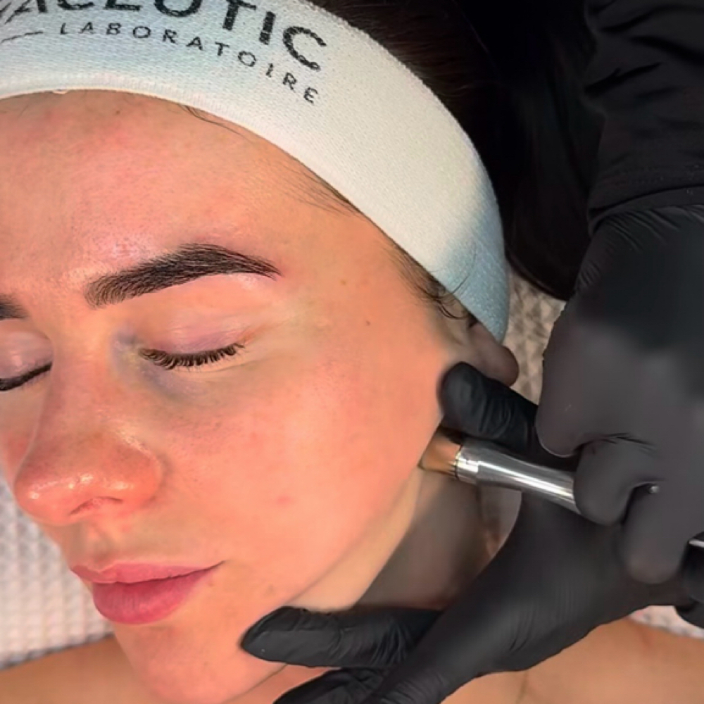 Microdermabrasion (Add On) at Radiant Beauty By Selene in Fresno, CA