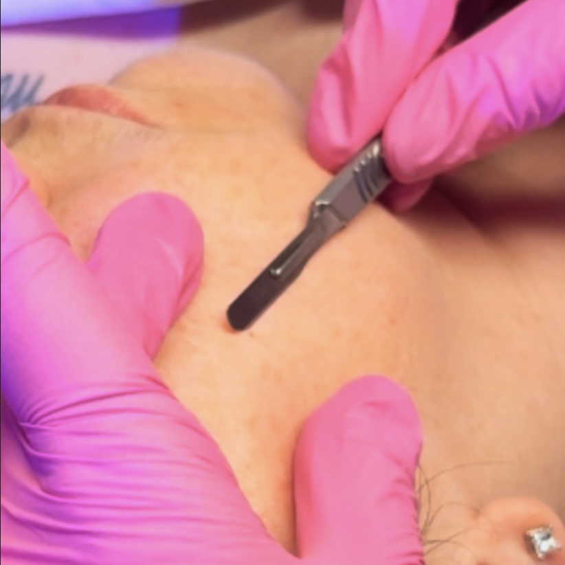 ADD ON: Dermaplaning