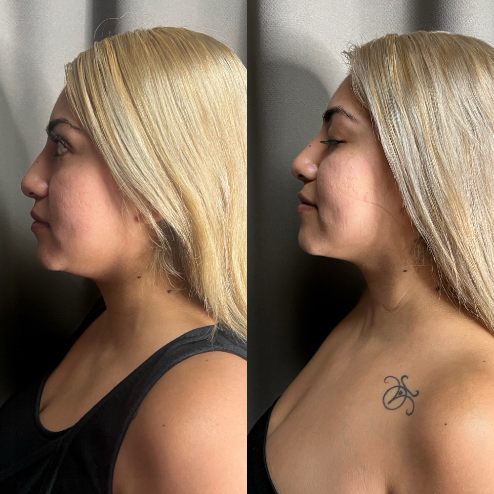 Face & Chin Contour  (6 Sessions)