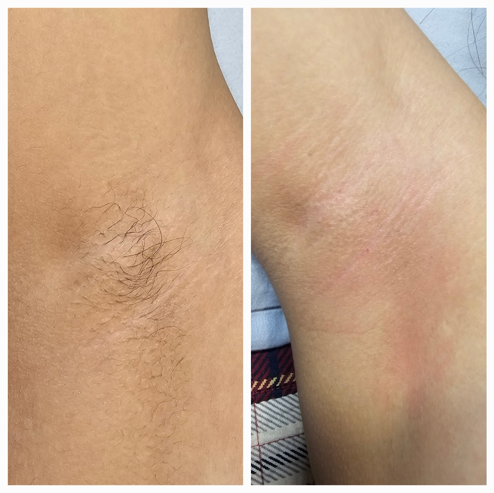 Underarm Waxing