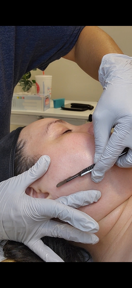 Dermaplaning