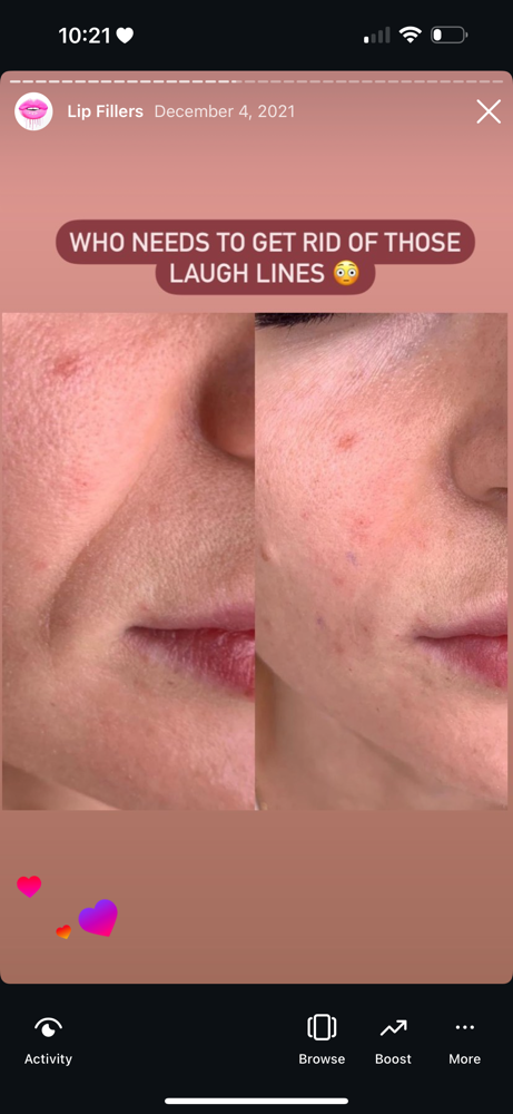 Filler For Deep Wrinkles (1ml)