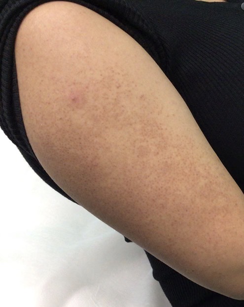 Keratosis Pilaris Arms (1 Treatmen