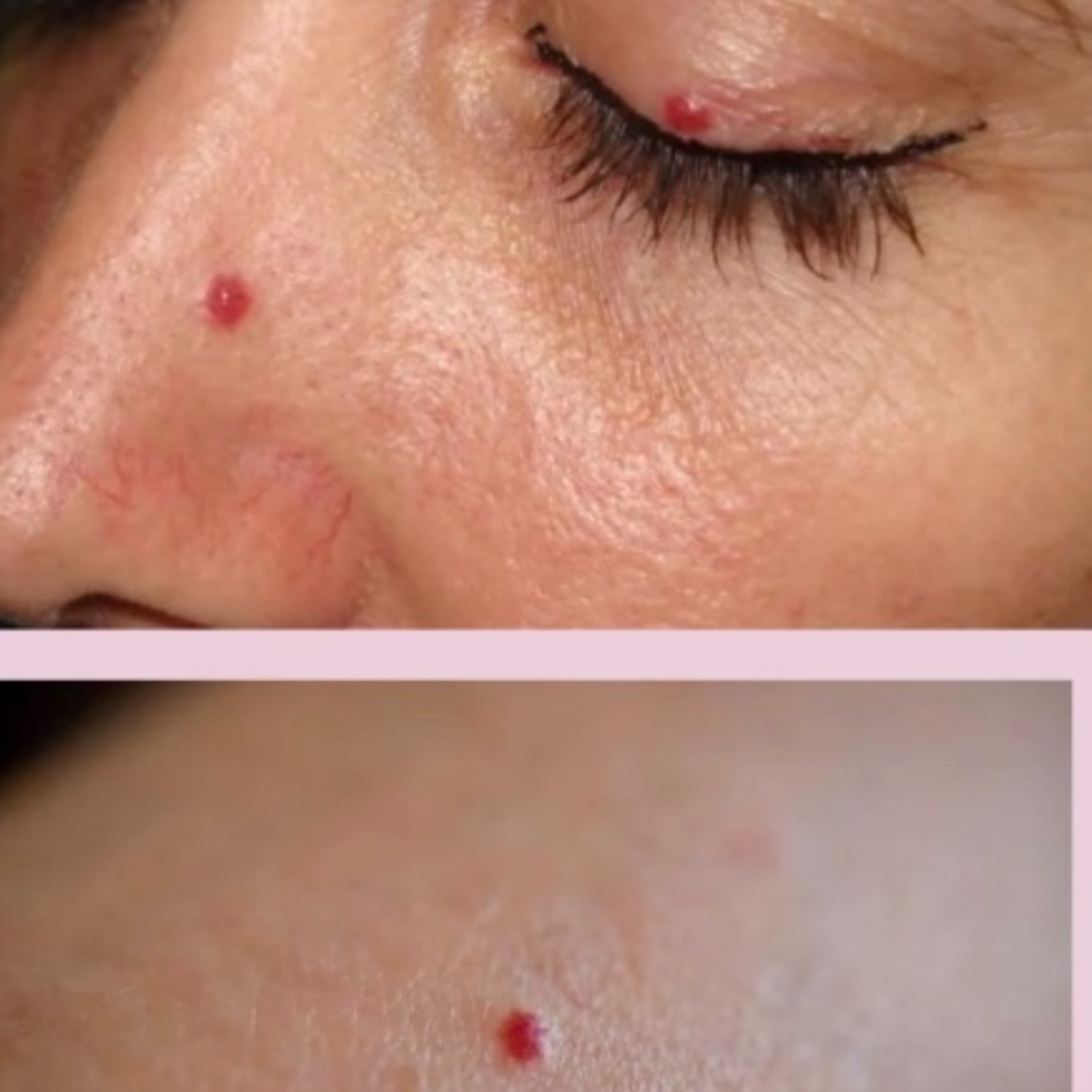 Cherry Angioma Removal at Serenity Aesthetics by Denise in St. John’s, FL