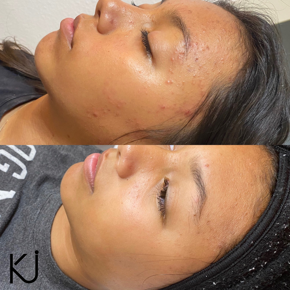 Acne Consultation & Acne Treatment