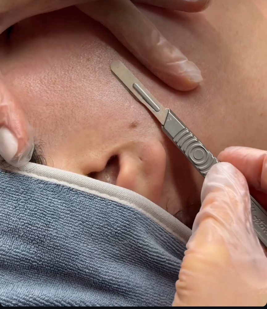 EPIDERMAL LEVELING FACIAL (add-on
