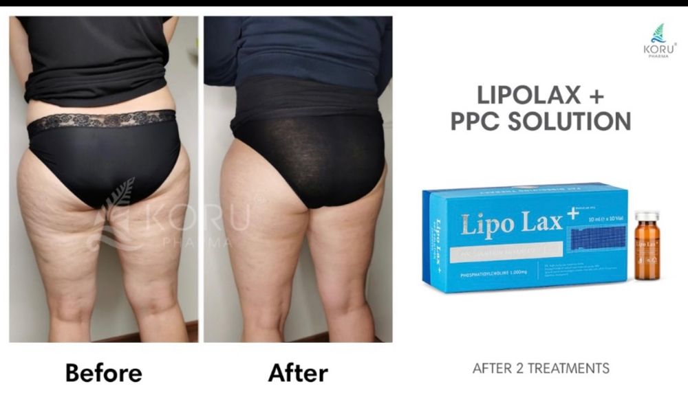 Lipo-Lax Thighs